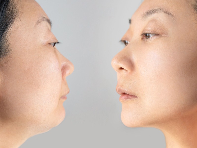 SMAS-lift-neck