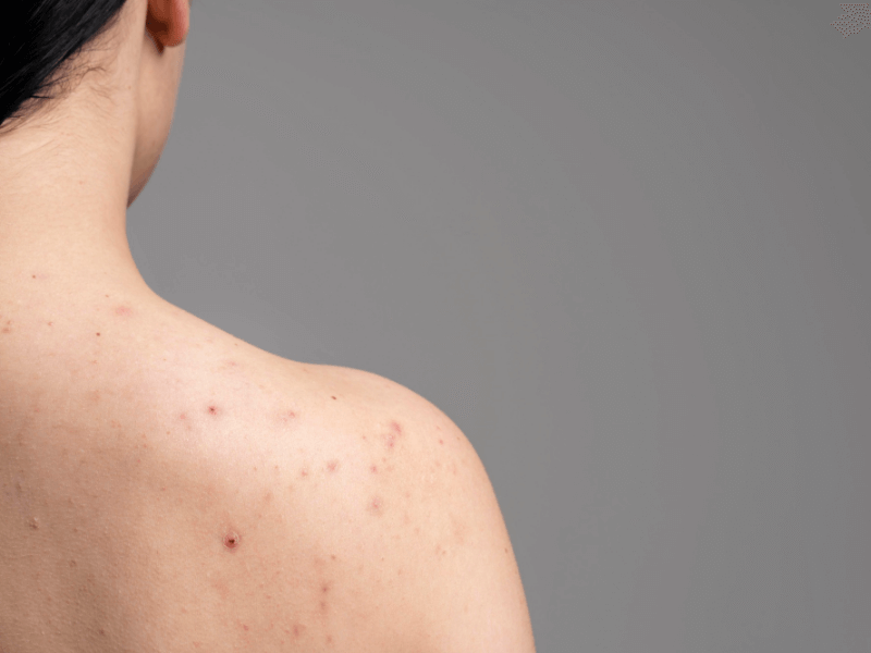 How to Choose the Ideal Bacne Fix for Your Skin in Singapore